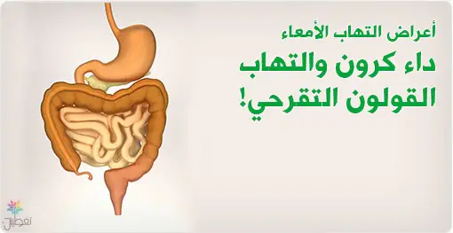 تقنية النانو: علاج حديث لالتهاب القولون