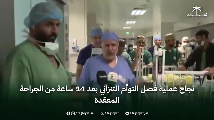 نجاح عملية فصل التوأم التنزاني بعد 14 ساعة من الجراحة المعقدة
