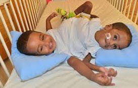 فصل التوأم السوداني: عملية معقدة