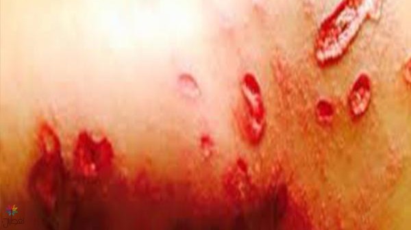 حرق الابنة: تفاصيل الحادث والحماية الأمنية
