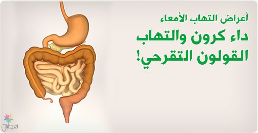 تقنية النانو: علاج حديث لالتهاب القولون