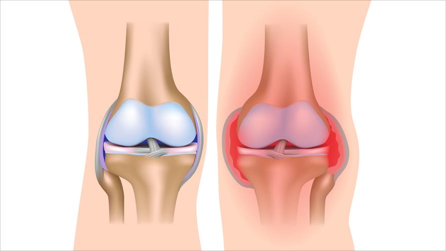 6 علاجات طبيعية لالتهاب المفاصل