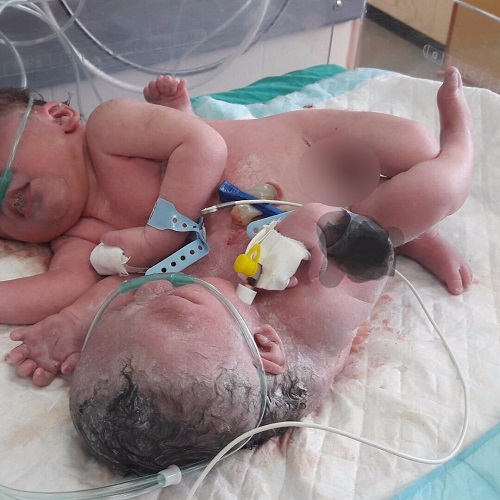 ولي العهد يوجه بنقل التوأم السيامي حنين وفرح من غزه إلى الرياض للعلاج وإمكانية فصلهما