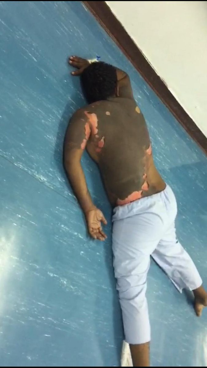 حرق مواطن بـ"الزيت المغلي" على يد زوجته.. وصحة بيشة تكشف ملابسات