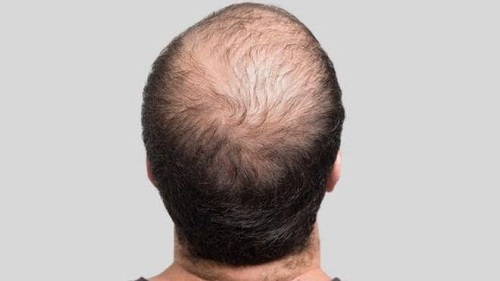 اكتشاف علاج جديد يعزز نمو الشعر ويقضي على الصلع