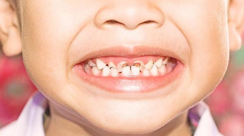 تسوس الأسنان: 9 أسباب و3 إرشادات