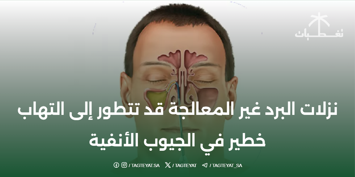 نزلات البرد غير المعالجة قد تتطور إلى التهاب خطير في الجيوب الأنفية