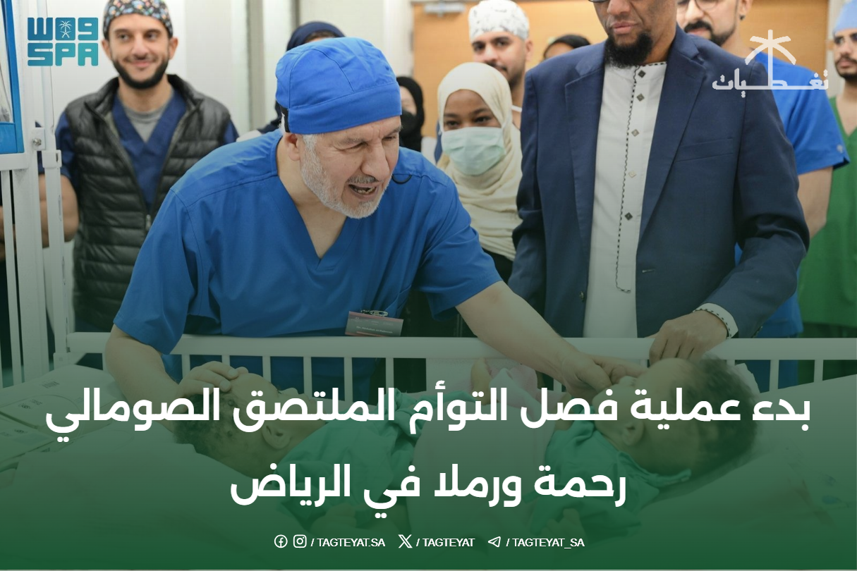 بدء عملية فصل التوأم الملتصق الصومالي رحمة ورملا في الرياض
