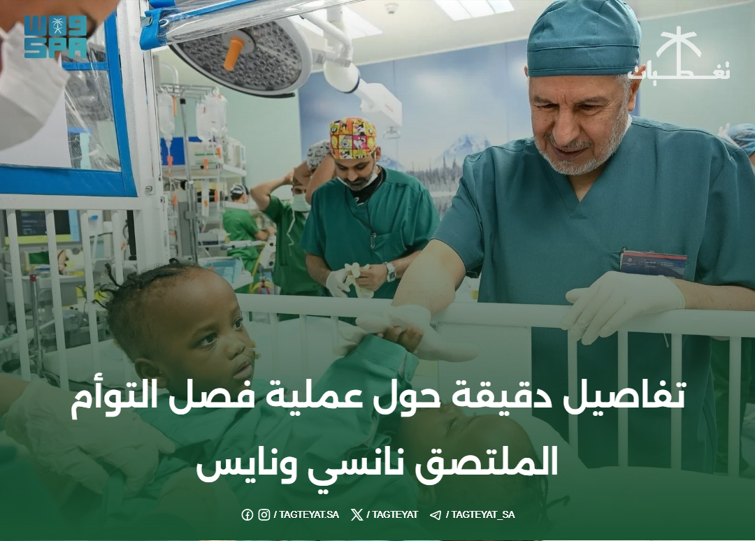 تفاصيل دقيقة حول عملية فصل التوأم الملتصق نانسي ونايس