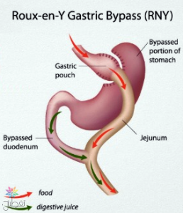 gastric bypass